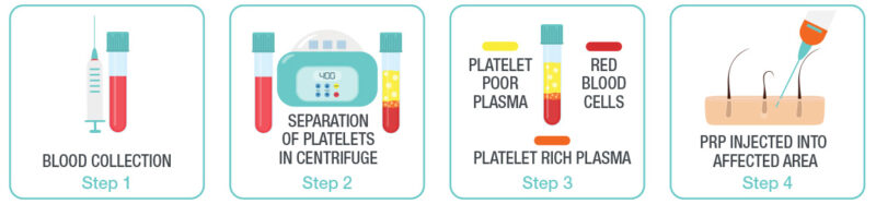 Platelet Rich Plasma Steps 1 to 4